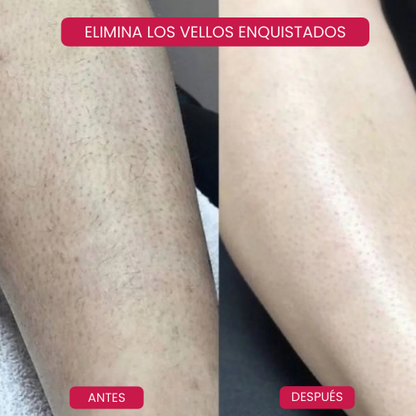 ¡Por fin, una Piel perfecta sin Sufrimiento!