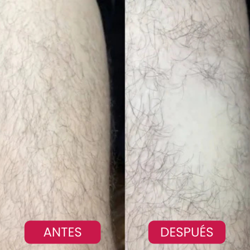 ¡Por fin, una Piel perfecta sin Sufrimiento!